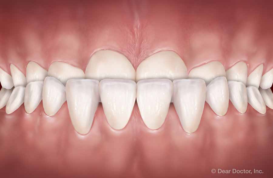 mild underbite
