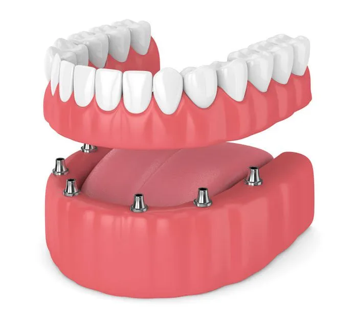 Types of Dentures