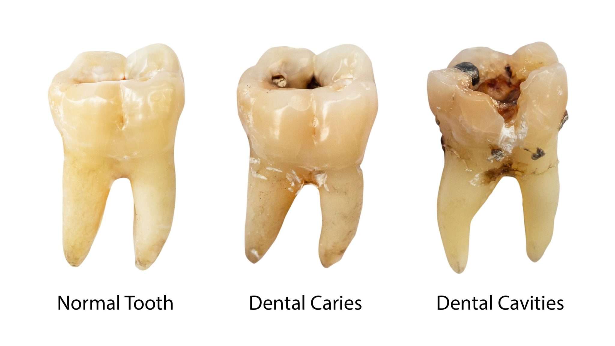 Cavities
