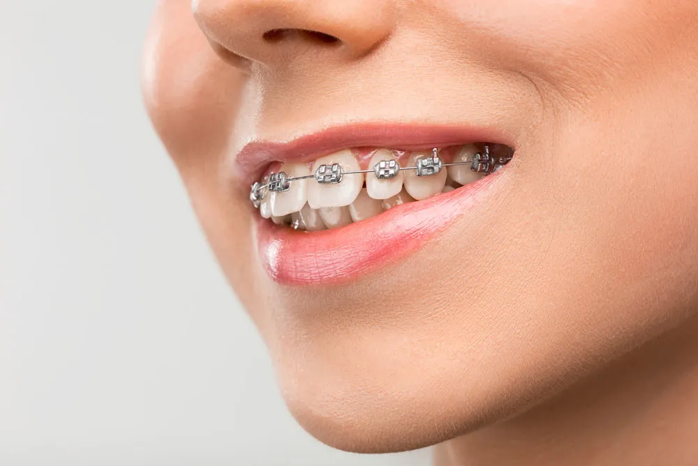 overbite
