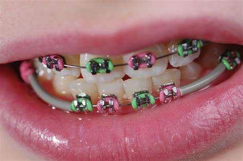 Braces colours