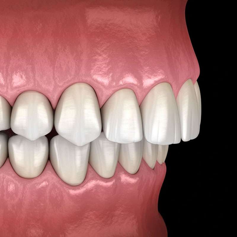 overbite