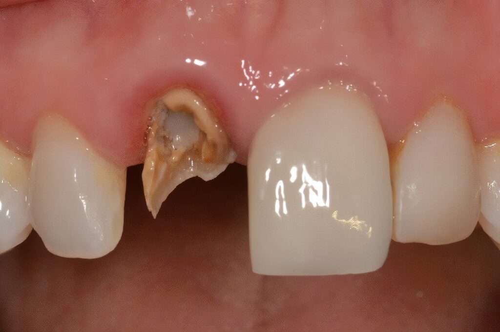 Broken Tooth Root in The Gum