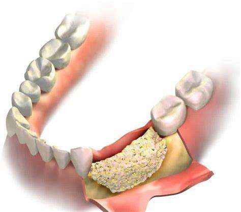 Understanding Bone Grafting for Dental Implants