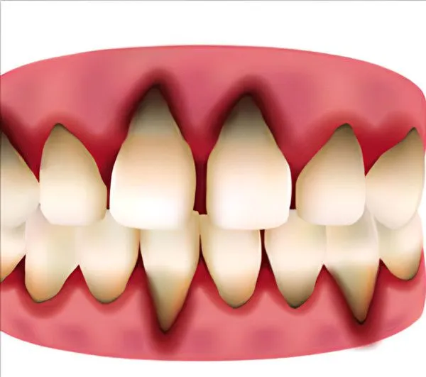 Gum Recession