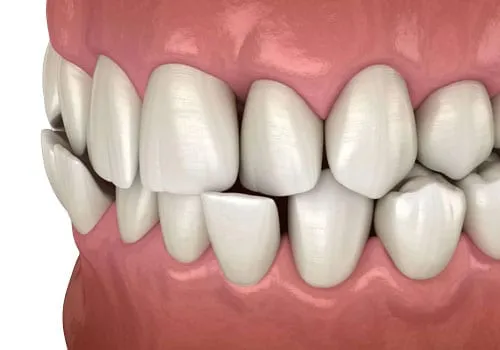 Crossbite