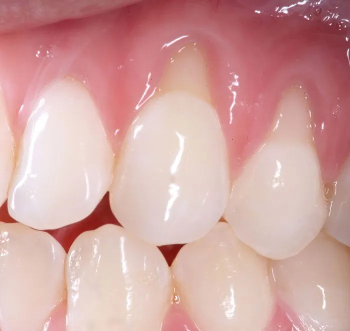 Gum Recession