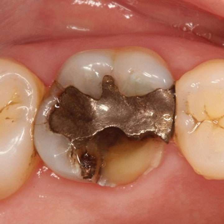 Broken Tooth Root in The Gum