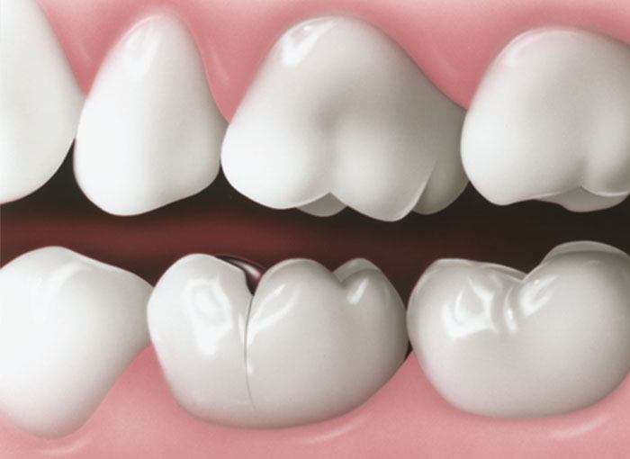 Repair Your Cracked Tooth