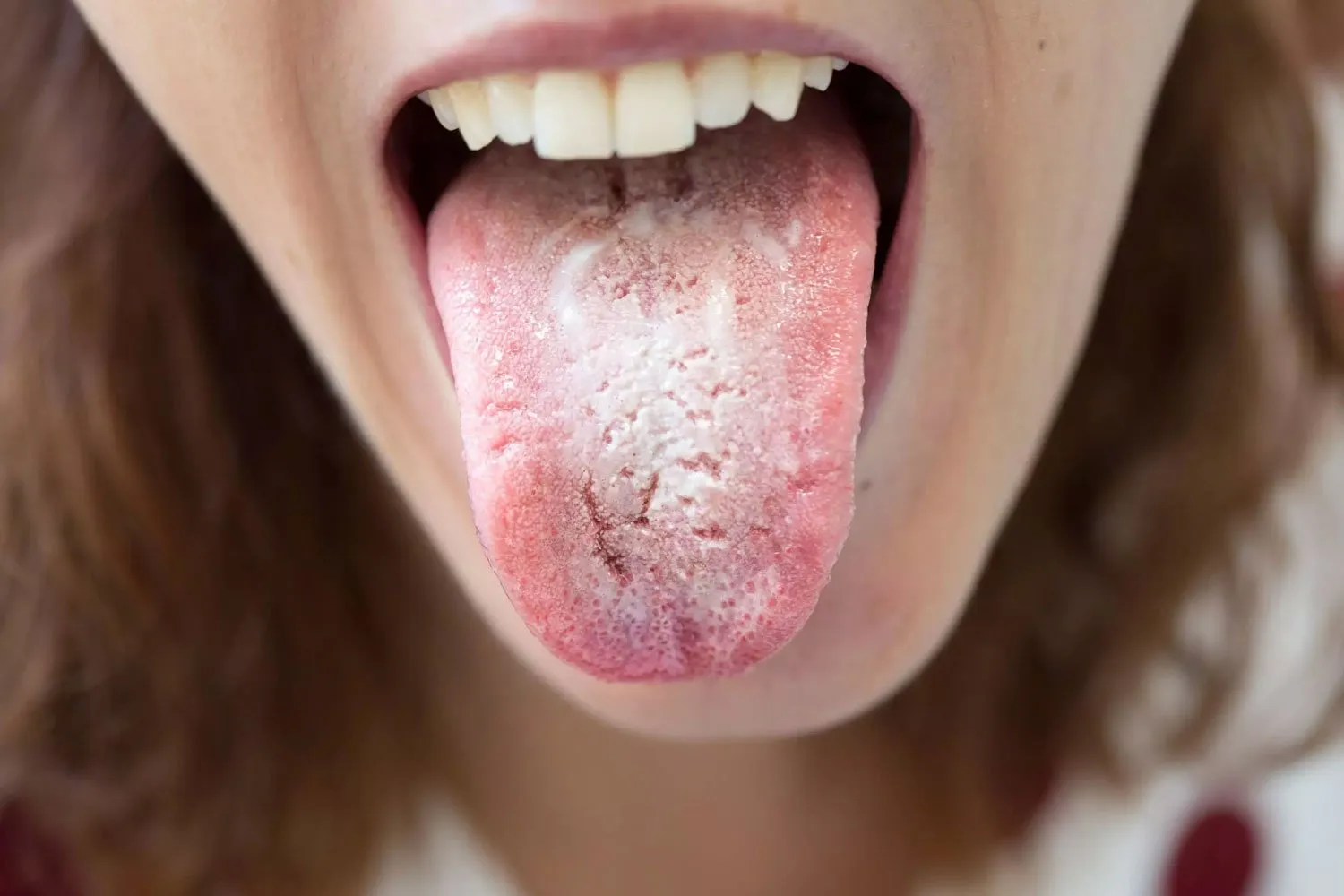 Hydrogen Peroxide and Oral Thrush