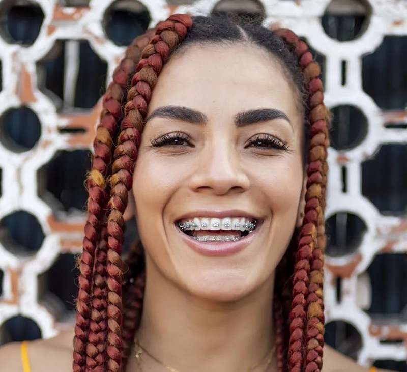 Dental Braces colours