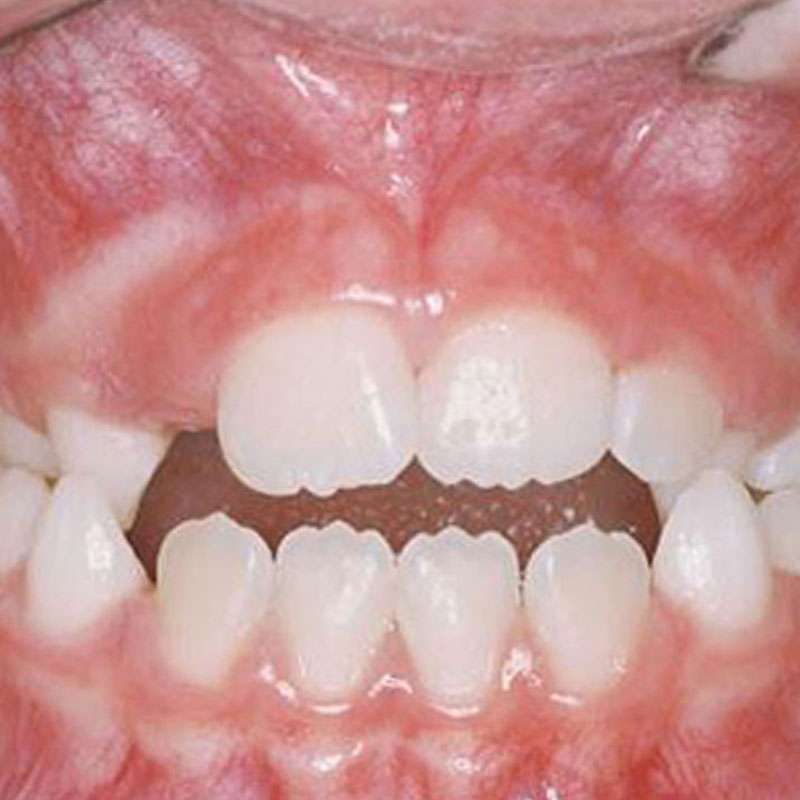 Crossbite