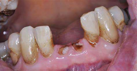 Broken Tooth Root in The Gum
