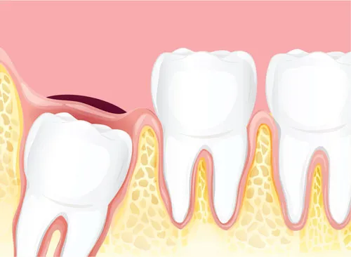 Wisdom Tooth Extraction