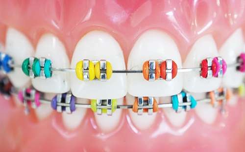Braces colours