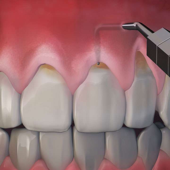 Gum Recession