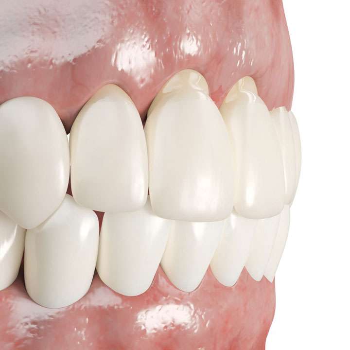 Gum Recession