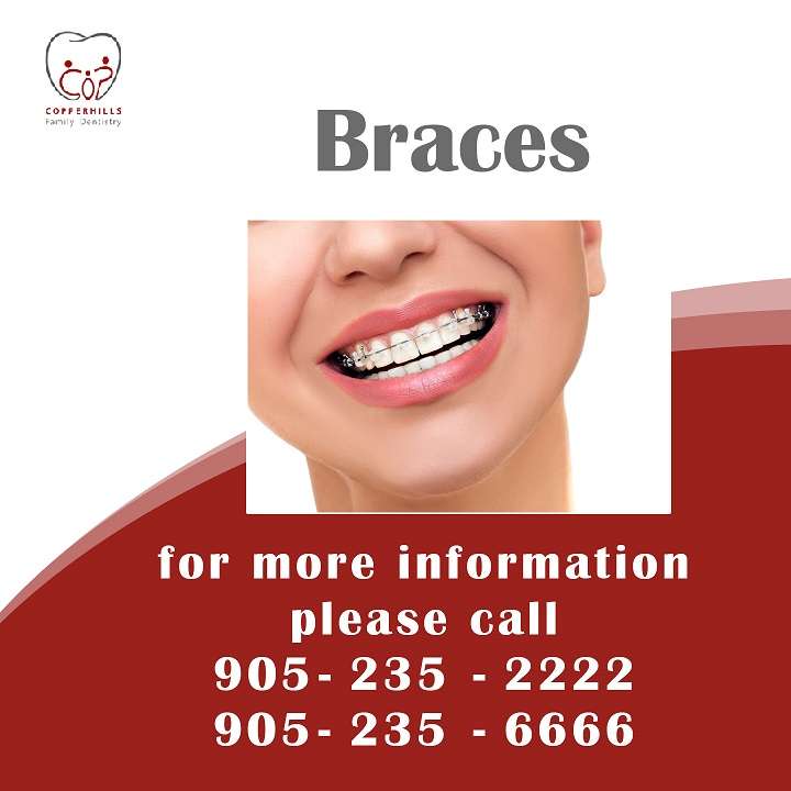 11 Things to Know Before Getting Dental Braces