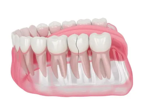 Repair Your Cracked Tooth