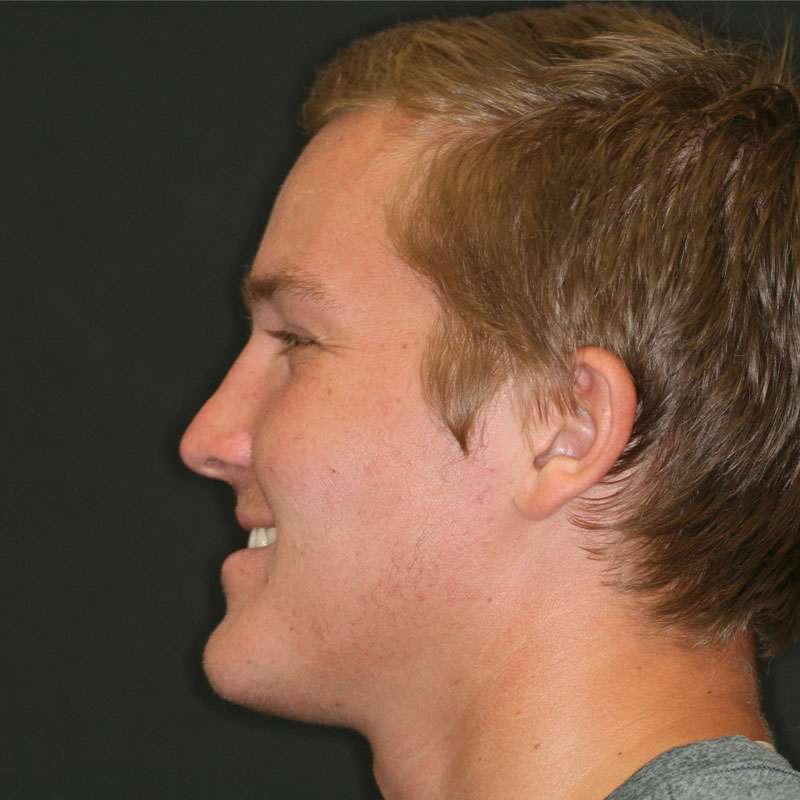 What Is An Underbite