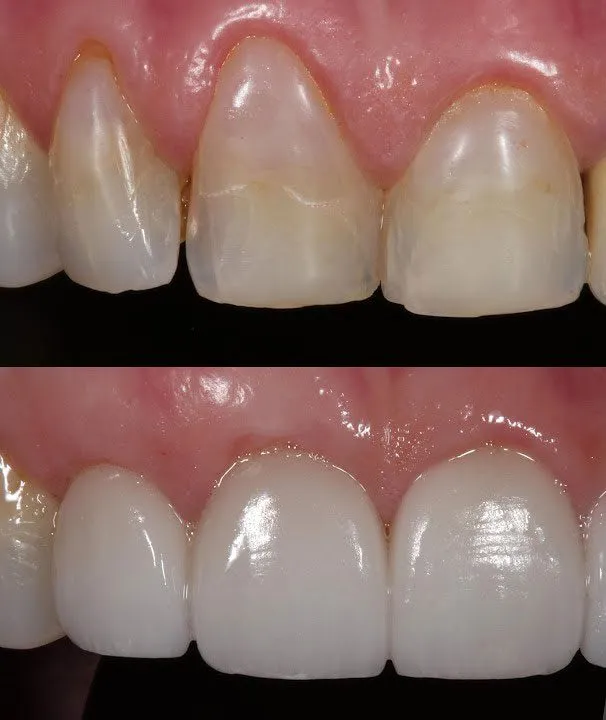 {"type":"elementor","siteurl":"https://copperhillsfamilydentistry.com/wp-json/","elements":[{"id":"01c74ad","elType":"widget","isInner":false,"isLocked":false,"settings":{"image":{"id":6340,"url":"https://copperhillsfamilydentistry.com/wp-content/uploads/2022/12/Gum-Recession-3.jpg","alt":"Gum Recession","source":"library"},"image_size":"full","image_border_radius":{"unit":"px","top":"300","right":"100","bottom":"100","left":"100","isLinked":""},"image_box_shadow_box_shadow_type":"yes","image_box_shadow_box_shadow":{"horizontal":5,"vertical":5,"blur":10,"spread":"0","color":"rgba(0,0,0,0.12)"},"_margin":{"unit":"px","top":"","right":"","bottom":"","left":"","isLinked":""},"_element_custom_width":{"unit":"px","size":"540","sizes":[]},"_offset_x":{"size":"0","unit":"px"},"_offset_y":{"size":"0","unit":"px"},"_margin_tablet":{"unit":"px","top":"0","right":"0","bottom":"-50","left":"0","isLinked":""},"_margin_mobile":{"unit":"px","top":"0","right":"0","bottom":"0","left":"0","isLinked":""},"motion_fx_motion_fx_scrolling":"yes","motion_fx_translateY_effect":"yes","motion_fx_translateY_speed":{"unit":"px","size":"1","sizes":[]},"width_tablet":{"unit":"%","size":"100","sizes":[]},"_animation":"fadeInDown","motion_fx_translateX_direction":"negative","motion_fx_opacity_direction":"in-out","motion_fx_rotateZ_speed":{"unit":"px","size":"0.5","sizes":[]},"motion_fx_rotateZ_affectedRange":{"unit":"%","size":"","sizes":{"start":"39","end":"100"}},"motion_fx_scale_direction":"in-out","motion_fx_transform_origin_x":"left","motion_fx_transform_origin_y":"top","width":{"unit":"%","size":100,"sizes":[]},"animation_duration":"slow","image_custom_dimension":{"width":"","height":""},"align":"","align_tablet":"","align_mobile":"","caption_source":"none","caption":"","link_to":"none","link":{"url":"","is_external":"","nofollow":"","custom_attributes":""},"open_lightbox":"default","view":"traditional","width_mobile":{"unit":"%","size":"","sizes":[]},"space":{"unit":"%","size":"","sizes":[]},"space_tablet":{"unit":"%","size":"","sizes":[]},"space_mobile":{"unit":"%","size":"","sizes":[]},"height":{"unit":"px","size":"","sizes":[]},"height_tablet":{"unit":"px","size":"","sizes":[]},"height_mobile":{"unit":"px","size":"","sizes":[]},"object-fit":"","object-fit_tablet":"","object-fit_mobile":"","object-position":"center center","object-position_tablet":"","object-position_mobile":"","opacity":{"unit":"px","size":"","sizes":[]},"css_filters_css_filter":"","css_filters_blur":{"unit":"px","size":0,"sizes":[]},"css_filters_brightness":{"unit":"px","size":100,"sizes":[]},"css_filters_contrast":{"unit":"px","size":100,"sizes":[]},"css_filters_saturate":{"unit":"px","size":100,"sizes":[]},"css_filters_hue":{"unit":"px","size":0,"sizes":[]},"opacity_hover":{"unit":"px","size":"","sizes":[]},"css_filters_hover_css_filter":"","css_filters_hover_blur":{"unit":"px","size":0,"sizes":[]},"css_filters_hover_brightness":{"unit":"px","size":100,"sizes":[]},"css_filters_hover_contrast":{"unit":"px","size":100,"sizes":[]},"css_filters_hover_saturate":{"unit":"px","size":100,"sizes":[]},"css_filters_hover_hue":{"unit":"px","size":0,"sizes":[]},"background_hover_transition":{"unit":"px","size":"","sizes":[]},"hover_animation":"","image_border_border":"","image_border_width":{"unit":"px","top":"","right":"","bottom":"","left":"","isLinked":true},"image_border_width_tablet":{"unit":"px","top":"","right":"","bottom":"","left":"","isLinked":true},"image_border_width_mobile":{"unit":"px","top":"","right":"","bottom":"","left":"","isLinked":true},"image_border_color":"","image_border_radius_tablet":{"unit":"px","top":"","right":"","bottom":"","left":"","isLinked":true},"image_border_radius_mobile":{"unit":"px","top":"","right":"","bottom":"","left":"","isLinked":true},"caption_align":"","caption_align_tablet":"","caption_align_mobile":"","text_color":"","caption_background_color":"","caption_typography_typography":"","caption_typography_font_family":"","caption_typography_font_size":{"unit":"px","size":"","sizes":[]},"caption_typography_font_size_tablet":{"unit":"px","size":"","sizes":[]},"caption_typography_font_size_mobile":{"unit":"px","size":"","sizes":[]},"caption_typography_font_weight":"","caption_typography_text_transform":"","caption_typography_font_style":"","caption_typography_text_decoration":"","caption_typography_line_height":{"unit":"px","size":"","sizes":[]},"caption_typography_line_height_tablet":{"unit":"em","size":"","sizes":[]},"caption_typography_line_height_mobile":{"unit":"em","size":"","sizes":[]},"caption_typography_letter_spacing":{"unit":"px","size":"","sizes":[]},"caption_typography_letter_spacing_tablet":{"unit":"px","size":"","sizes":[]},"caption_typography_letter_spacing_mobile":{"unit":"px","size":"","sizes":[]},"caption_typography_word_spacing":{"unit":"px","size":"","sizes":[]},"caption_typography_word_spacing_tablet":{"unit":"em","size":"","sizes":[]},"caption_typography_word_spacing_mobile":{"unit":"em","size":"","sizes":[]},"caption_text_shadow_text_shadow_type":"","caption_text_shadow_text_shadow":{"horizontal":0,"vertical":0,"blur":10,"color":"rgba(0,0,0,0.3)"},"caption_space":{"unit":"px","size":"","sizes":[]},"caption_space_tablet":{"unit":"px","size":"","sizes":[]},"caption_space_mobile":{"unit":"px","size":"","sizes":[]},"_title":"","_padding":{"unit":"px","top":"","right":"","bottom":"","left":"","isLinked":true},"_padding_tablet":{"unit":"px","top":"","right":"","bottom":"","left":"","isLinked":true},"_padding_mobile":{"unit":"px","top":"","right":"","bottom":"","left":"","isLinked":true},"_element_width":"","_element_width_tablet":"","_element_width_mobile":"","_element_custom_width_tablet":{"unit":"px","size":"","sizes":[]},"_element_custom_width_mobile":{"unit":"px","size":"","sizes":[]},"_element_vertical_align":"","_element_vertical_align_tablet":"","_element_vertical_align_mobile":"","_position":"","_offset_orientation_h":"start","_offset_x_tablet":{"unit":"px","size":"","sizes":[]},"_offset_x_mobile":{"unit":"px","size":"","sizes":[]},"_offset_x_end":{"unit":"px","size":"0","sizes":[]},"_offset_x_end_tablet":{"unit":"px","size":"","sizes":[]},"_offset_x_end_mobile":{"unit":"px","size":"","sizes":[]},"_offset_orientation_v":"start","_offset_y_tablet":{"unit":"px","size":"","sizes":[]},"_offset_y_mobile":{"unit":"px","size":"","sizes":[]},"_offset_y_end":{"unit":"px","size":"0","sizes":[]},"_offset_y_end_tablet":{"unit":"px","size":"","sizes":[]},"_offset_y_end_mobile":{"unit":"px","size":"","sizes":[]},"_z_index":"","_z_index_tablet":"","_z_index_mobile":"","_element_id":"","_css_classes":"","motion_fx_translateY_direction":"","motion_fx_translateY_affectedRange":{"unit":"%","size":"","sizes":{"start":0,"end":100}},"motion_fx_translateX_effect":"","motion_fx_translateX_speed":{"unit":"px","size":4,"sizes":[]},"motion_fx_translateX_affectedRange":{"unit":"%","size":"","sizes":{"start":0,"end":100}},"motion_fx_opacity_effect":"","motion_fx_opacity_level":{"unit":"px","size":10,"sizes":[]},"motion_fx_opacity_range":{"unit":"%","size":"","sizes":{"start":20,"end":80}},"motion_fx_blur_effect":"","motion_fx_blur_direction":"out-in","motion_fx_blur_level":{"unit":"px","size":7,"sizes":[]},"motion_fx_blur_range":{"unit":"%","size":"","sizes":{"start":20,"end":80}},"motion_fx_rotateZ_effect":"","motion_fx_rotateZ_direction":"","motion_fx_scale_effect":"","motion_fx_scale_speed":{"unit":"px","size":4,"sizes":[]},"motion_fx_scale_range":{"unit":"%","size":"","sizes":{"start":20,"end":80}},"motion_fx_devices":["desktop","tablet","mobile"],"motion_fx_range":"","motion_fx_motion_fx_mouse":"","motion_fx_mouseTrack_effect":"","motion_fx_mouseTrack_direction":"","motion_fx_mouseTrack_speed":{"unit":"px","size":1,"sizes":[]},"motion_fx_tilt_effect":"","motion_fx_tilt_direction":"","motion_fx_tilt_speed":{"unit":"px","size":4,"sizes":[]},"sticky":"","sticky_on":["desktop","tablet","mobile"],"sticky_offset":0,"sticky_offset_tablet":"","sticky_offset_mobile":"","sticky_effects_offset":0,"sticky_effects_offset_tablet":"","sticky_effects_offset_mobile":"","sticky_parent":"","_animation_tablet":"","_animation_mobile":"","_animation_delay":"","_transform_rotate_popover":"","_transform_rotateZ_effect":{"unit":"px","size":"","sizes":[]},"_transform_rotateZ_effect_tablet":{"unit":"deg","size":"","sizes":[]},"_transform_rotateZ_effect_mobile":{"unit":"deg","size":"","sizes":[]},"_transform_rotate_3d":"","_transform_rotateX_effect":{"unit":"px","size":"","sizes":[]},"_transform_rotateX_effect_tablet":{"unit":"deg","size":"","sizes":[]},"_transform_rotateX_effect_mobile":{"unit":"deg","size":"","sizes":[]},"_transform_rotateY_effect":{"unit":"px","size":"","sizes":[]},"_transform_rotateY_effect_tablet":{"unit":"deg","size":"","sizes":[]},"_transform_rotateY_effect_mobile":{"unit":"deg","size":"","sizes":[]},"_transform_perspective_effect":{"unit":"px","size":"","sizes":[]},"_transform_perspective_effect_tablet":{"unit":"px","size":"","sizes":[]},"_transform_perspective_effect_mobile":{"unit":"px","size":"","sizes":[]},"_transform_translate_popover":"","_transform_translateX_effect":{"unit":"px","size":"","sizes":[]},"_transform_translateX_effect_tablet":{"unit":"px","size":"","sizes":[]},"_transform_translateX_effect_mobile":{"unit":"px","size":"","sizes":[]},"_transform_translateY_effect":{"unit":"px","size":"","sizes":[]},"_transform_translateY_effect_tablet":{"unit":"px","size":"","sizes":[]},"_transform_translateY_effect_mobile":{"unit":"px","size":"","sizes":[]},"_transform_scale_popover":"","_transform_keep_proportions":"yes","_transform_scale_effect":{"unit":"px","size":"","sizes":[]},"_transform_scale_effect_tablet":{"unit":"px","size":"","sizes":[]},"_transform_scale_effect_mobile":{"unit":"px","size":"","sizes":[]},"_transform_scaleX_effect":{"unit":"px","size":"","sizes":[]},"_transform_scaleX_effect_tablet":{"unit":"px","size":"","sizes":[]},"_transform_scaleX_effect_mobile":{"unit":"px","size":"","sizes":[]},"_transform_scaleY_effect":{"unit":"px","size":"","sizes":[]},"_transform_scaleY_effect_tablet":{"unit":"px","size":"","sizes":[]},"_transform_scaleY_effect_mobile":{"unit":"px","size":"","sizes":[]},"_transform_skew_popover":"","_transform_skewX_effect":{"unit":"px","size":"","sizes":[]},"_transform_skewX_effect_tablet":{"unit":"deg","size":"","sizes":[]},"_transform_skewX_effect_mobile":{"unit":"deg","size":"","sizes":[]},"_transform_skewY_effect":{"unit":"px","size":"","sizes":[]},"_transform_skewY_effect_tablet":{"unit":"deg","size":"","sizes":[]},"_transform_skewY_effect_mobile":{"unit":"deg","size":"","sizes":[]},"_transform_flipX_effect":"","_transform_flipY_effect":"","_transform_rotate_popover_hover":"","_transform_rotateZ_effect_hover":{"unit":"px","size":"","sizes":[]},"_transform_rotateZ_effect_hover_tablet":{"unit":"deg","size":"","sizes":[]},"_transform_rotateZ_effect_hover_mobile":{"unit":"deg","size":"","sizes":[]},"_transform_rotate_3d_hover":"","_transform_rotateX_effect_hover":{"unit":"px","size":"","sizes":[]},"_transform_rotateX_effect_hover_tablet":{"unit":"deg","size":"","sizes":[]},"_transform_rotateX_effect_hover_mobile":{"unit":"deg","size":"","sizes":[]},"_transform_rotateY_effect_hover":{"unit":"px","size":"","sizes":[]},"_transform_rotateY_effect_hover_tablet":{"unit":"deg","size":"","sizes":[]},"_transform_rotateY_effect_hover_mobile":{"unit":"deg","size":"","sizes":[]},"_transform_perspective_effect_hover":{"unit":"px","size":"","sizes":[]},"_transform_perspective_effect_hover_tablet":{"unit":"px","size":"","sizes":[]},"_transform_perspective_effect_hover_mobile":{"unit":"px","size":"","sizes":[]},"_transform_translate_popover_hover":"","_transform_translateX_effect_hover":{"unit":"px","size":"","sizes":[]},"_transform_translateX_effect_hover_tablet":{"unit":"px","size":"","sizes":[]},"_transform_translateX_effect_hover_mobile":{"unit":"px","size":"","sizes":[]},"_transform_translateY_effect_hover":{"unit":"px","size":"","sizes":[]},"_transform_translateY_effect_hover_tablet":{"unit":"px","size":"","sizes":[]},"_transform_translateY_effect_hover_mobile":{"unit":"px","size":"","sizes":[]},"_transform_scale_popover_hover":"","_transform_keep_proportions_hover":"yes","_transform_scale_effect_hover":{"unit":"px","size":"","sizes":[]},"_transform_scale_effect_hover_tablet":{"unit":"px","size":"","sizes":[]},"_transform_scale_effect_hover_mobile":{"unit":"px","size":"","sizes":[]},"_transform_scaleX_effect_hover":{"unit":"px","size":"","sizes":[]},"_transform_scaleX_effect_hover_tablet":{"unit":"px","size":"","sizes":[]},"_transform_scaleX_effect_hover_mobile":{"unit":"px","size":"","sizes":[]},"_transform_scaleY_effect_hover":{"unit":"px","size":"","sizes":[]},"_transform_scaleY_effect_hover_tablet":{"unit":"px","size":"","sizes":[]},"_transform_scaleY_effect_hover_mobile":{"unit":"px","size":"","sizes":[]},"_transform_skew_popover_hover":"","_transform_skewX_effect_hover":{"unit":"px","size":"","sizes":[]},"_transform_skewX_effect_hover_tablet":{"unit":"deg","size":"","sizes":[]},"_transform_skewX_effect_hover_mobile":{"unit":"deg","size":"","sizes":[]},"_transform_skewY_effect_hover":{"unit":"px","size":"","sizes":[]},"_transform_skewY_effect_hover_tablet":{"unit":"deg","size":"","sizes":[]},"_transform_skewY_effect_hover_mobile":{"unit":"deg","size":"","sizes":[]},"_transform_flipX_effect_hover":"","_transform_flipY_effect_hover":"","_transform_transition_hover":{"unit":"px","size":"","sizes":[]},"motion_fx_transform_x_anchor_point":"","motion_fx_transform_x_anchor_point_tablet":"","motion_fx_transform_x_anchor_point_mobile":"","motion_fx_transform_y_anchor_point":"","motion_fx_transform_y_anchor_point_tablet":"","motion_fx_transform_y_anchor_point_mobile":"","_background_background":"","_background_color":"","_background_color_stop":{"unit":"%","size":0,"sizes":[]},"_background_color_b":"#f2295b","_background_color_b_stop":{"unit":"%","size":100,"sizes":[]},"_background_gradient_type":"linear","_background_gradient_angle":{"unit":"deg","size":180,"sizes":[]},"_background_gradient_position":"center center","_background_image":{"url":"","id":"","size":""},"_background_image_tablet":{"url":"","id":"","size":""},"_background_image_mobile":{"url":"","id":"","size":""},"_background_position":"","_background_position_tablet":"","_background_position_mobile":"","_background_xpos":{"unit":"px","size":0,"sizes":[]},"_background_xpos_tablet":{"unit":"px","size":0,"sizes":[]},"_background_xpos_mobile":{"unit":"px","size":0,"sizes":[]},"_background_ypos":{"unit":"px","size":0,"sizes":[]},"_background_ypos_tablet":{"unit":"px","size":0,"sizes":[]},"_background_ypos_mobile":{"unit":"px","size":0,"sizes":[]},"_background_attachment":"","_background_repeat":"","_background_repeat_tablet":"","_background_repeat_mobile":"","_background_size":"","_background_size_tablet":"","_background_size_mobile":"","_background_bg_width":{"unit":"%","size":100,"sizes":[]},"_background_bg_width_tablet":{"unit":"px","size":"","sizes":[]},"_background_bg_width_mobile":{"unit":"px","size":"","sizes":[]},"_background_video_link":"","_background_video_start":"","_background_video_end":"","_background_play_once":"","_background_play_on_mobile":"","_background_privacy_mode":"","_background_video_fallback":{"url":"","id":"","size":""},"_background_slideshow_gallery":[],"_background_slideshow_loop":"yes","_background_slideshow_slide_duration":5000,"_background_slideshow_slide_transition":"fade","_background_slideshow_transition_duration":500,"_background_slideshow_background_size":"","_background_slideshow_background_size_tablet":"","_background_slideshow_background_size_mobile":"","_background_slideshow_background_position":"","_background_slideshow_background_position_tablet":"","_background_slideshow_background_position_mobile":"","_background_slideshow_lazyload":"","_background_slideshow_ken_burns":"","_background_slideshow_ken_burns_zoom_direction":"in","_background_hover_background":"","_background_hover_color":"","_background_hover_color_stop":{"unit":"%","size":0,"sizes":[]},"_background_hover_color_b":"#f2295b","_background_hover_color_b_stop":{"unit":"%","size":100,"sizes":[]},"_background_hover_gradient_type":"linear","_background_hover_gradient_angle":{"unit":"deg","size":180,"sizes":[]},"_background_hover_gradient_position":"center center","_background_hover_image":{"url":"","id":"","size":""},"_background_hover_image_tablet":{"url":"","id":"","size":""},"_background_hover_image_mobile":{"url":"","id":"","size":""},"_background_hover_position":"","_background_hover_position_tablet":"","_background_hover_position_mobile":"","_background_hover_xpos":{"unit":"px","size":0,"sizes":[]},"_background_hover_xpos_tablet":{"unit":"px","size":0,"sizes":[]},"_background_hover_xpos_mobile":{"unit":"px","size":0,"sizes":[]},"_background_hover_ypos":{"unit":"px","size":0,"sizes":[]},"_background_hover_ypos_tablet":{"unit":"px","size":0,"sizes":[]},"_background_hover_ypos_mobile":{"unit":"px","size":0,"sizes":[]},"_background_hover_attachment":"","_background_hover_repeat":"","_background_hover_repeat_tablet":"","_background_hover_repeat_mobile":"","_background_hover_size":"","_background_hover_size_tablet":"","_background_hover_size_mobile":"","_background_hover_bg_width":{"unit":"%","size":100,"sizes":[]},"_background_hover_bg_width_tablet":{"unit":"px","size":"","sizes":[]},"_background_hover_bg_width_mobile":{"unit":"px","size":"","sizes":[]},"_background_hover_video_link":"","_background_hover_video_start":"","_background_hover_video_end":"","_background_hover_play_once":"","_background_hover_play_on_mobile":"","_background_hover_privacy_mode":"","_background_hover_video_fallback":{"url":"","id":"","size":""},"_background_hover_slideshow_gallery":[],"_background_hover_slideshow_loop":"yes","_background_hover_slideshow_slide_duration":5000,"_background_hover_slideshow_slide_transition":"fade","_background_hover_slideshow_transition_duration":500,"_background_hover_slideshow_background_size":"","_background_hover_slideshow_background_size_tablet":"","_background_hover_slideshow_background_size_mobile":"","_background_hover_slideshow_background_position":"","_background_hover_slideshow_background_position_tablet":"","_background_hover_slideshow_background_position_mobile":"","_background_hover_slideshow_lazyload":"","_background_hover_slideshow_ken_burns":"","_background_hover_slideshow_ken_burns_zoom_direction":"in","_background_hover_transition":{"unit":"px","size":"","sizes":[]},"_border_border":"","_border_width":{"unit":"px","top":"","right":"","bottom":"","left":"","isLinked":true},"_border_width_tablet":{"unit":"px","top":"","right":"","bottom":"","left":"","isLinked":true},"_border_width_mobile":{"unit":"px","top":"","right":"","bottom":"","left":"","isLinked":true},"_border_color":"","_border_radius":{"unit":"px","top":"","right":"","bottom":"","left":"","isLinked":true},"_border_radius_tablet":{"unit":"px","top":"","right":"","bottom":"","left":"","isLinked":true},"_border_radius_mobile":{"unit":"px","top":"","right":"","bottom":"","left":"","isLinked":true},"_box_shadow_box_shadow_type":"","_box_shadow_box_shadow":{"horizontal":0,"vertical":0,"blur":10,"spread":0,"color":"rgba(0,0,0,0.5)"},"_box_shadow_box_shadow_position":" ","_border_hover_border":"","_border_hover_width":{"unit":"px","top":"","right":"","bottom":"","left":"","isLinked":true},"_border_hover_width_tablet":{"unit":"px","top":"","right":"","bottom":"","left":"","isLinked":true},"_border_hover_width_mobile":{"unit":"px","top":"","right":"","bottom":"","left":"","isLinked":true},"_border_hover_color":"","_border_radius_hover":{"unit":"px","top":"","right":"","bottom":"","left":"","isLinked":true},"_border_radius_hover_tablet":{"unit":"px","top":"","right":"","bottom":"","left":"","isLinked":true},"_border_radius_hover_mobile":{"unit":"px","top":"","right":"","bottom":"","left":"","isLinked":true},"_box_shadow_hover_box_shadow_type":"","_box_shadow_hover_box_shadow":{"horizontal":0,"vertical":0,"blur":10,"spread":0,"color":"rgba(0,0,0,0.5)"},"_box_shadow_hover_box_shadow_position":" ","_border_hover_transition":{"unit":"px","size":"","sizes":[]},"_mask_switch":"","_mask_shape":"circle","_mask_image":{"url":"","id":"","size":""},"_mask_notice":"","_mask_size":"contain","_mask_size_tablet":"","_mask_size_mobile":"","_mask_size_scale":{"unit":"%","size":100,"sizes":[]},"_mask_size_scale_tablet":{"unit":"px","size":"","sizes":[]},"_mask_size_scale_mobile":{"unit":"px","size":"","sizes":[]},"_mask_position":"center center","_mask_position_tablet":"","_mask_position_mobile":"","_mask_position_x":{"unit":"%","size":0,"sizes":[]},"_mask_position_x_tablet":{"unit":"px","size":"","sizes":[]},"_mask_position_x_mobile":{"unit":"px","size":"","sizes":[]},"_mask_position_y":{"unit":"%","size":0,"sizes":[]},"_mask_position_y_tablet":{"unit":"px","size":"","sizes":[]},"_mask_position_y_mobile":{"unit":"px","size":"","sizes":[]},"_mask_repeat":"no-repeat","_mask_repeat_tablet":"","_mask_repeat_mobile":"","hide_desktop":"","hide_tablet":"","hide_mobile":"","_attributes":"","custom_css":""},"defaultEditSettings":{"defaultEditRoute":"content"},"elements":[],"widgetType":"image","editSettings":{"defaultEditRoute":"content"},"htmlCache":""}]}