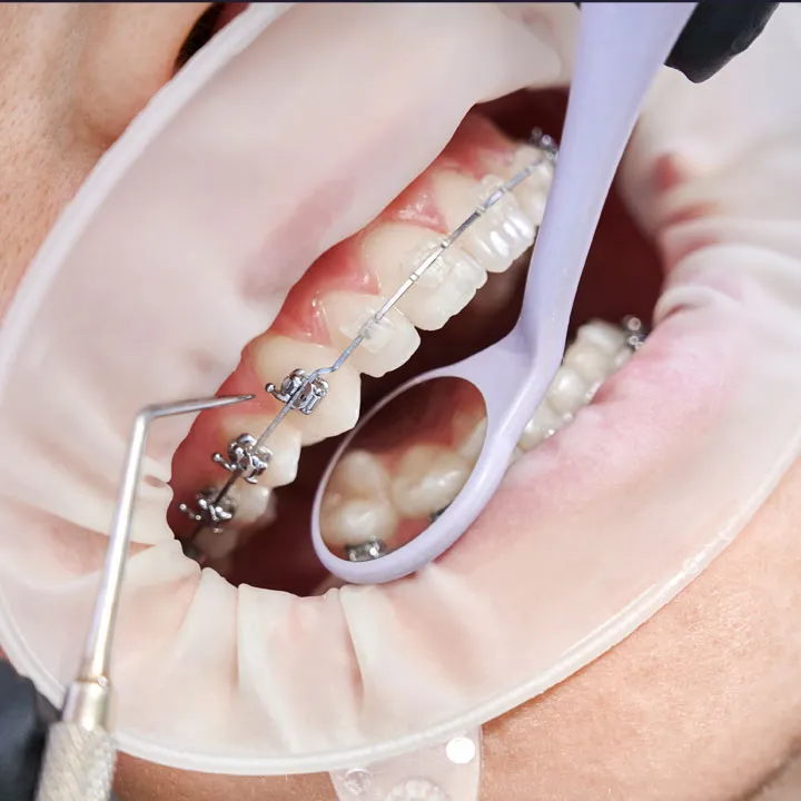 Dental Braces