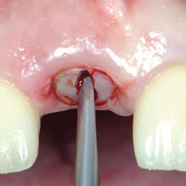 Ways to Extract Broken Root Tips