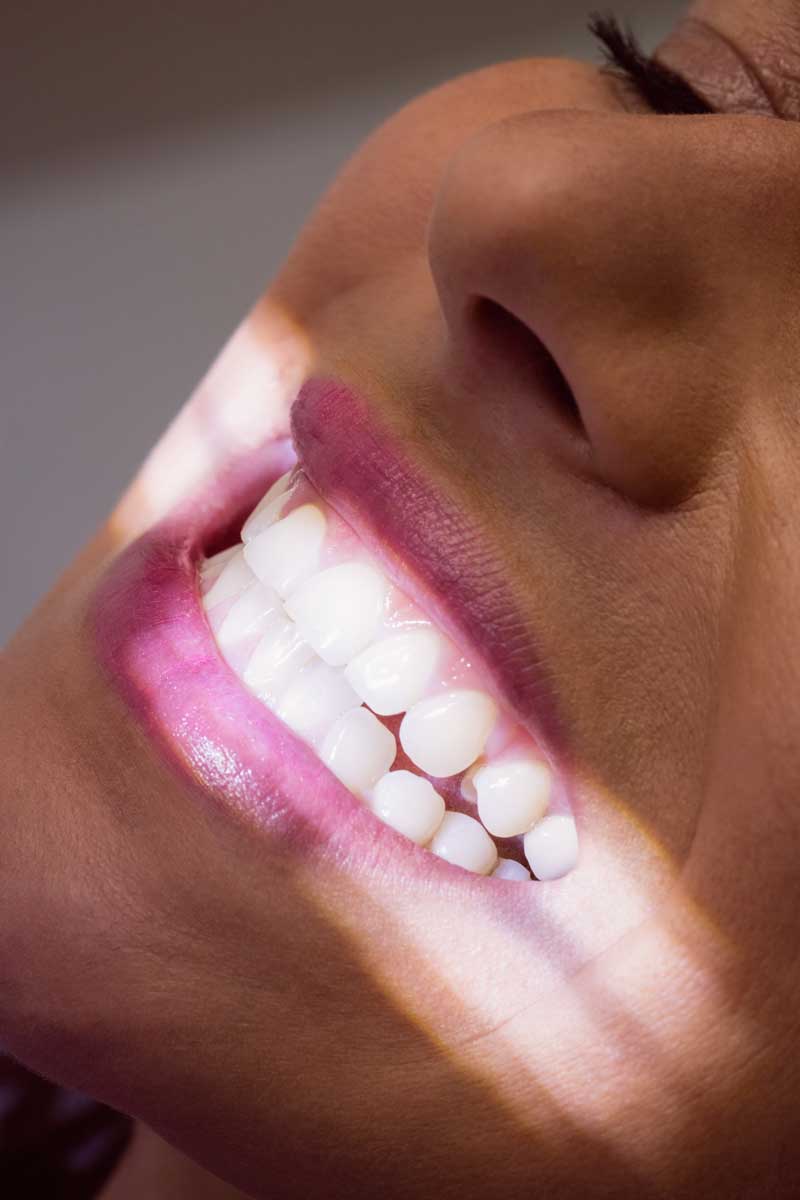 11 Things to Know Before Getting Dental Braces