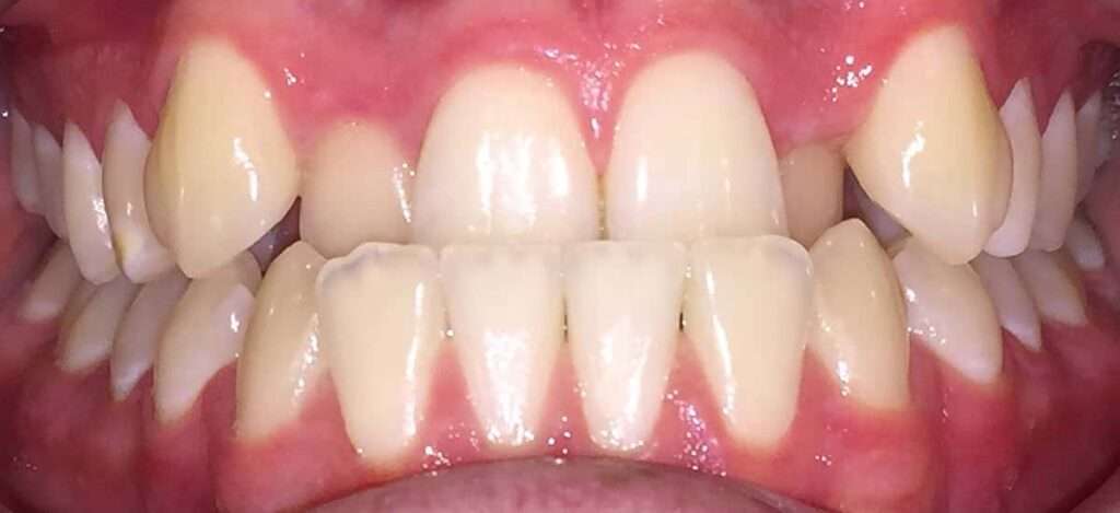 Underbite