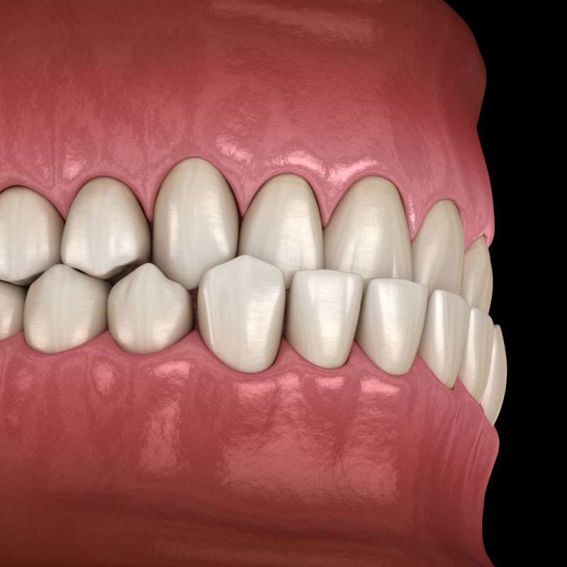 What Is An Underbite