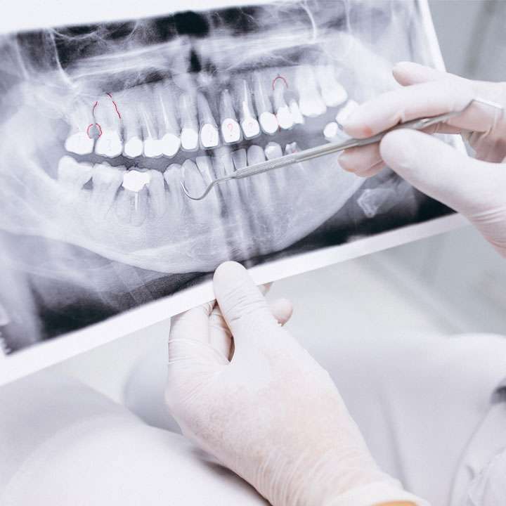 tooth decay symptoms