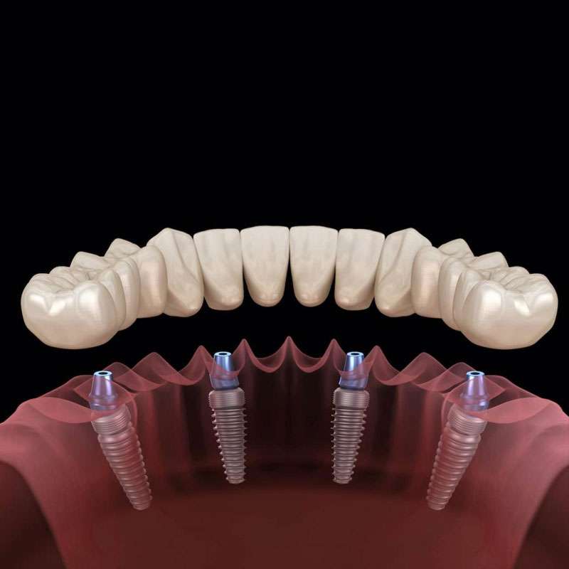 Types of Dentures