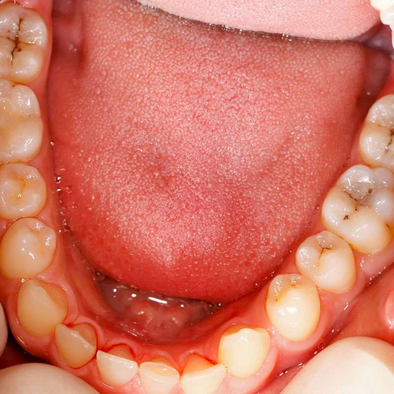 What Causes Cavities?
