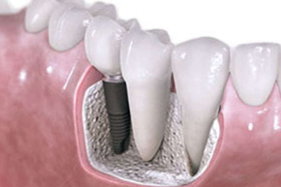 Understanding Bone Grafting for Dental Implants