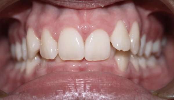 orthodontic treatment for deep bite