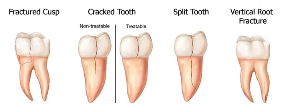 Repair Your Cracked Tooth