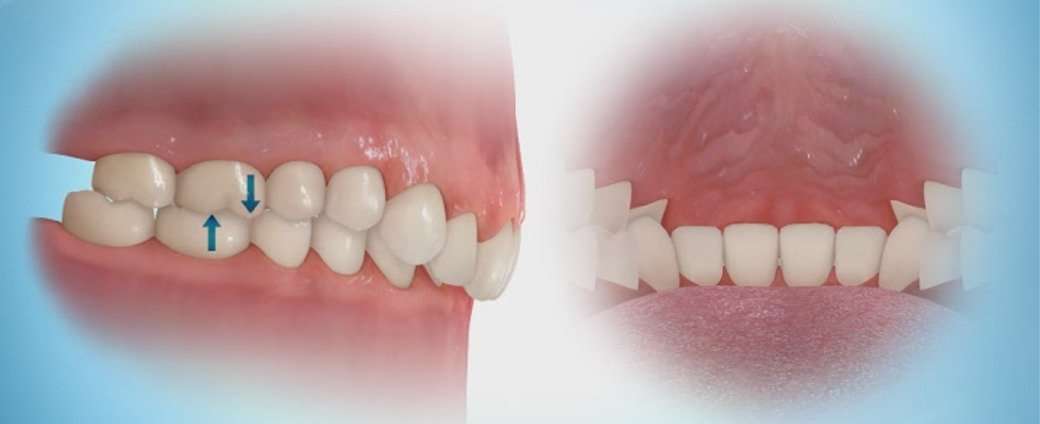 orthodontic treatment for deep bite