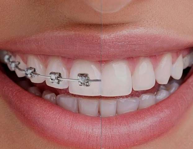 11 Things to Know Before Getting Dental Braces