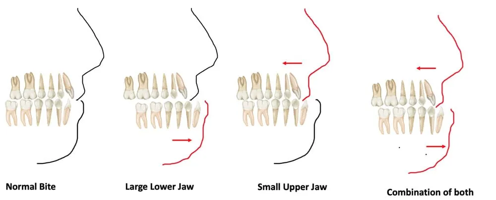 Underbite