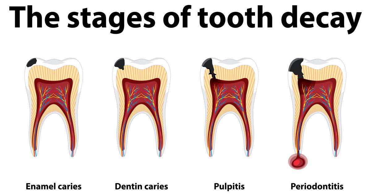 tooth decay symptoms