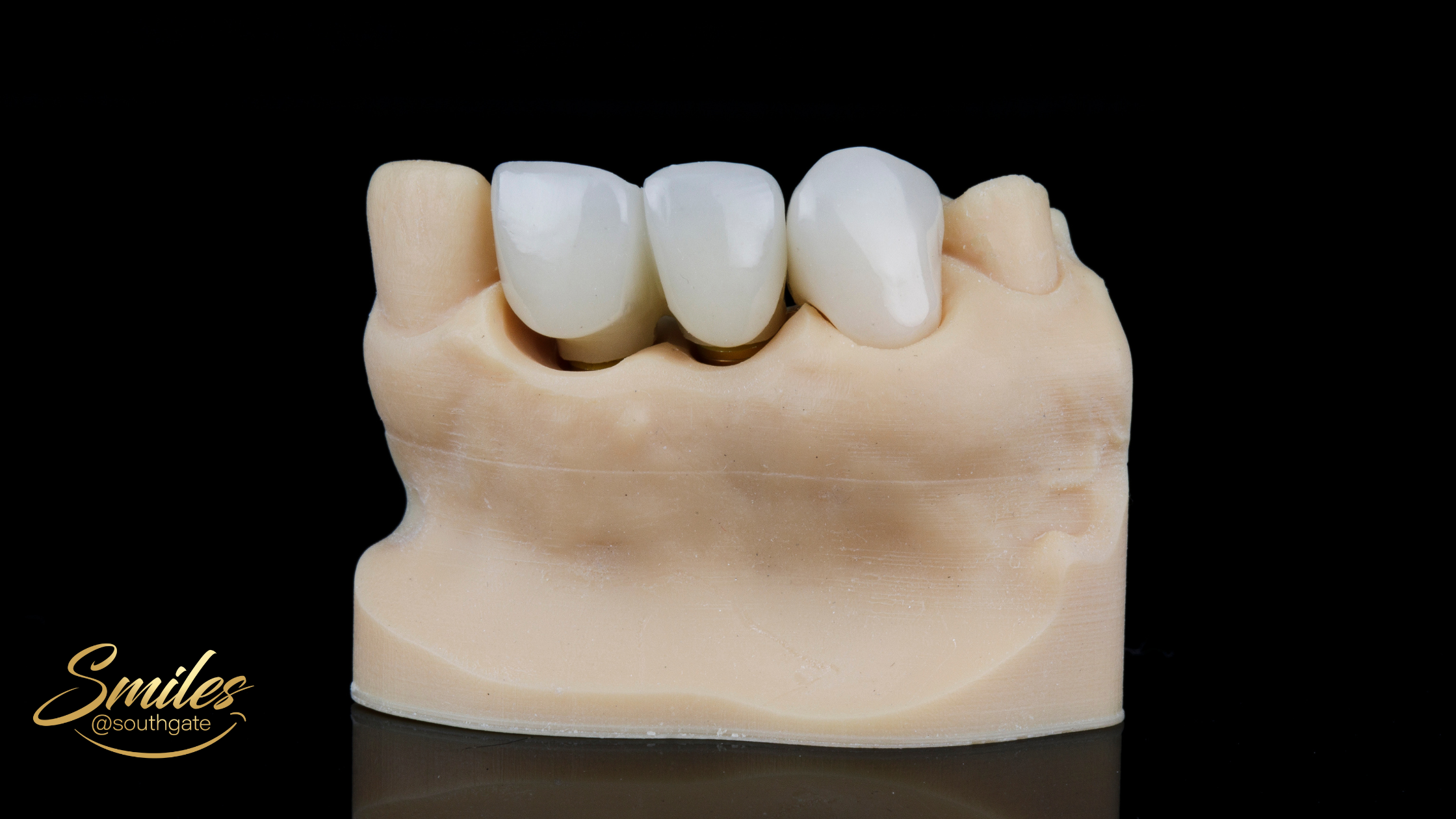 How to Tell If Your Dental Crown Is Too High
