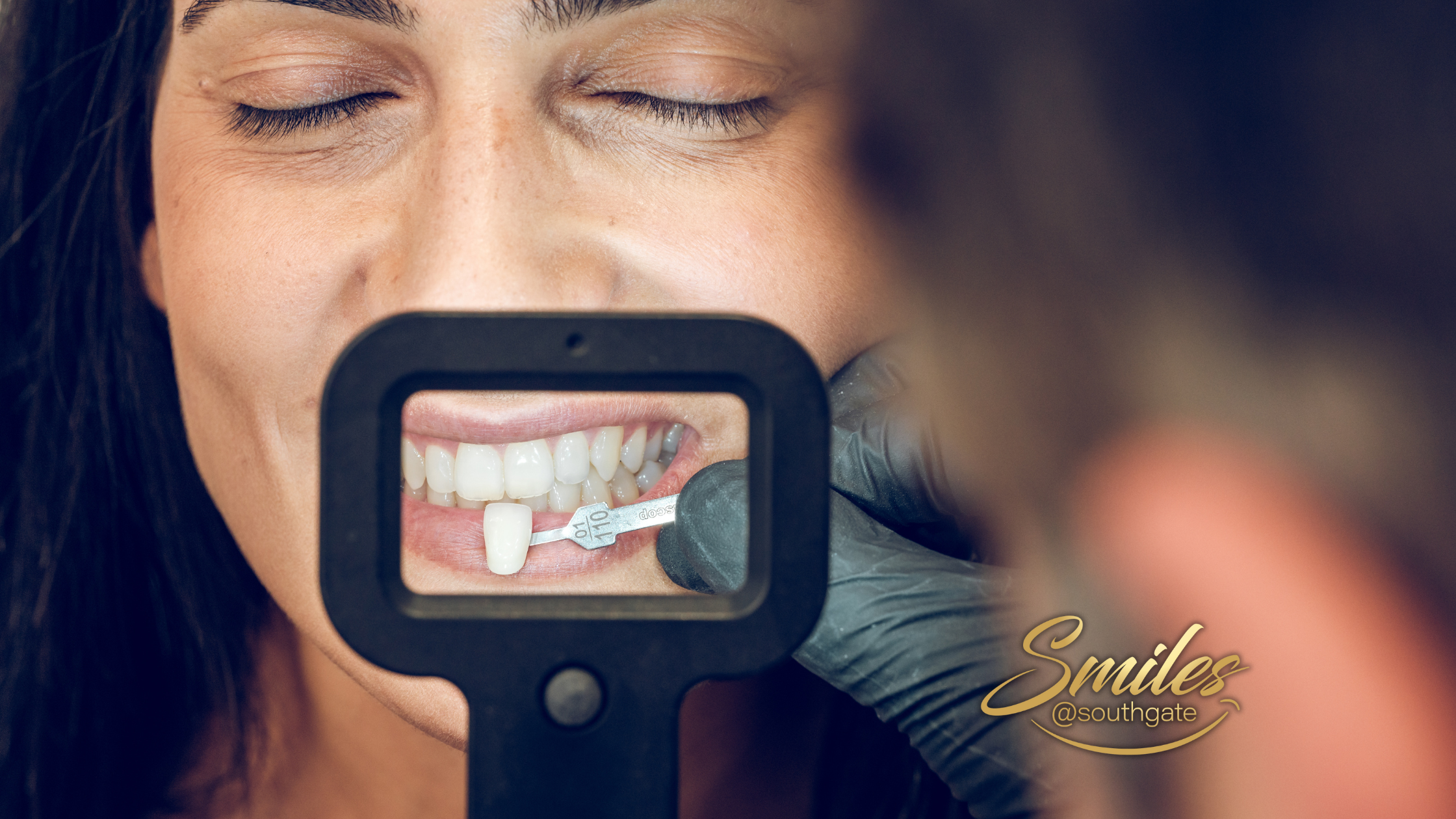 Dental Veneers vs. Lumineers - Which Is Right for You