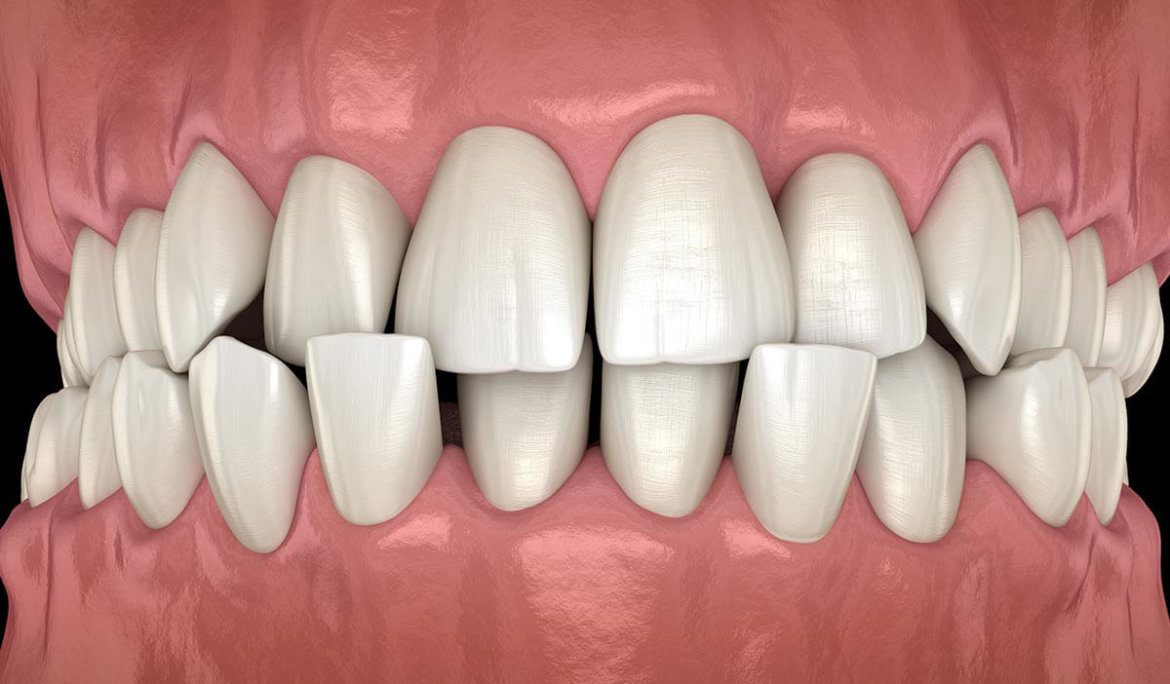 Dental crowding