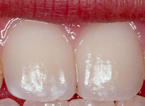 Dental Fluorosis