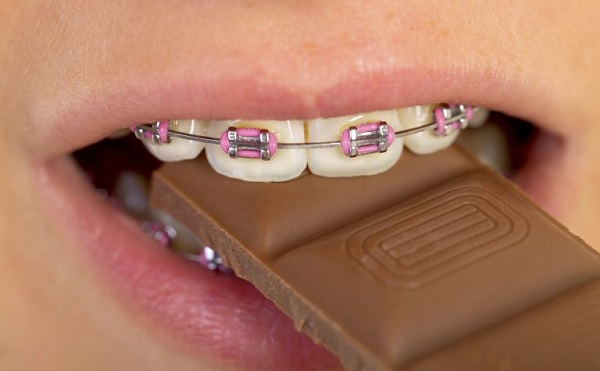 Eating Braces