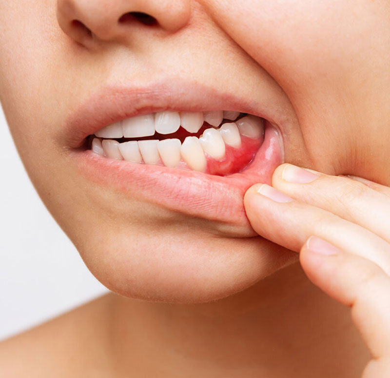 Swollen gums