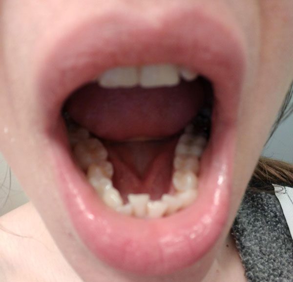 Dental crowding