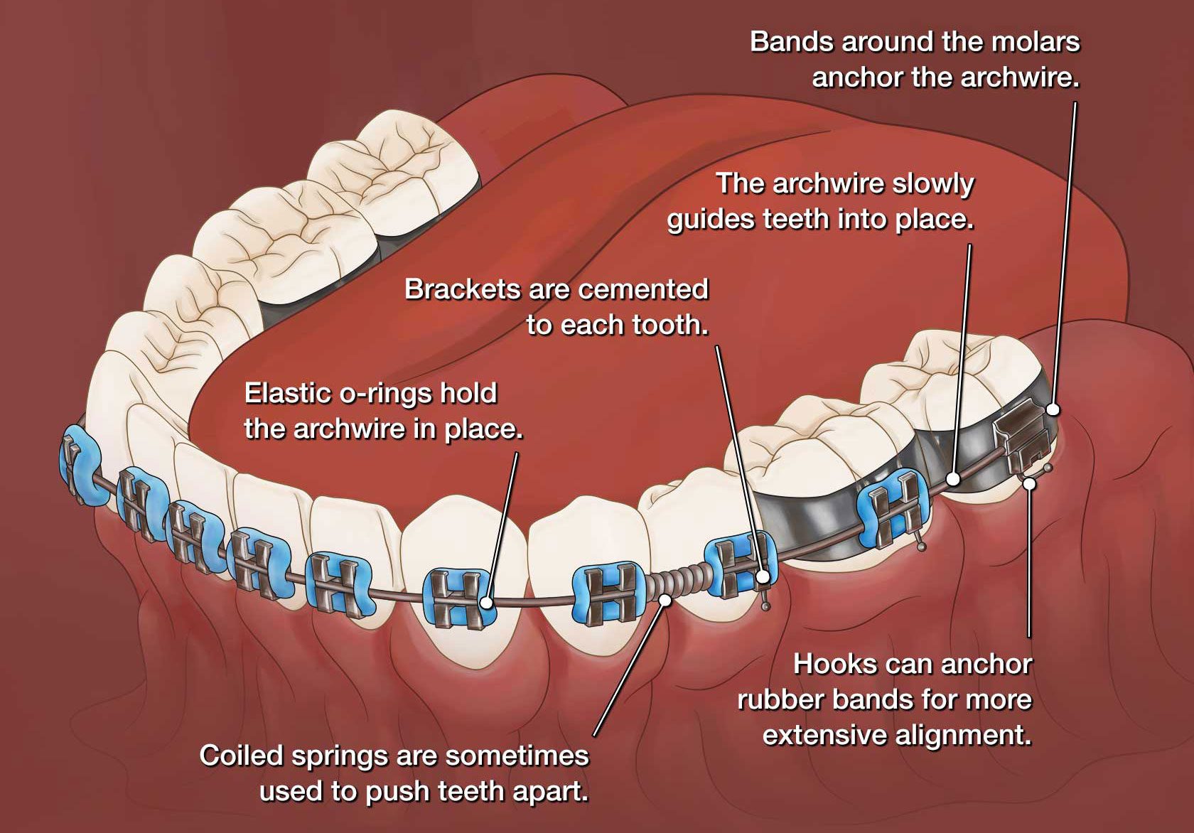 How Do Braces in Orthodontics Work?