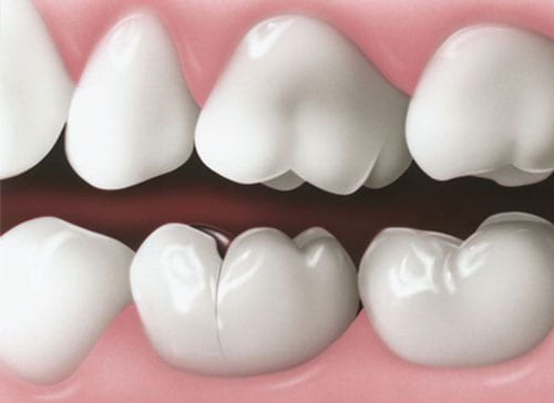 Understanding Cracked Tooth Treatment and Symptoms