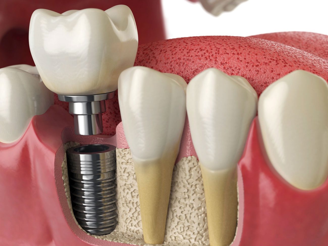 After Dental Implant